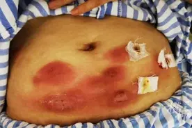 女网红注射“减脂神器”，全身感染进了医院，医生：真的会出人命……图片