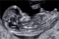 孕妈必看，你想知道的早孕期胎儿NT检查图片