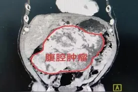 肿瘤重约10斤！ 英德人医成功开展微创腹腔镜辅助下巨大肿瘤切除术图片