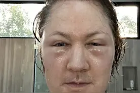 曾尝试换血减龄的美亿万富翁自曝整脸翻车：脸肿到眼睛看不见，下次继续图片