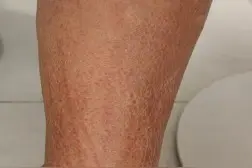 女子吃完香菇汤双腿现鞭打痕图片