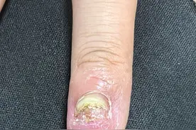 原来美甲这么伤！美甲高峰要来了，你的指甲还好吗图片