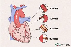 冠状动脉狭窄90％ 松山医院介入手术为患者打通血管图片