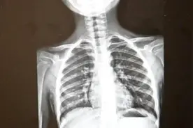 你家孩子脊柱侧弯吗？此病偏爱高瘦型和女孩，多做这些运动可预防|第医线图片