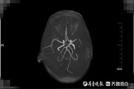 抢救七天七夜！青岛医生生死线上抢回9岁红斑狼疮娃图片