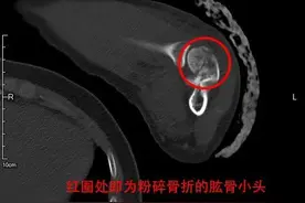 不慎骨折差点无法拿起手术刀？进修医生千里迢迢重回瑞金图片