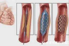 【杨柳科普】泛血管科普③：冠状动脉支架术和冠状动脉药物球囊术的区别是什么？图片