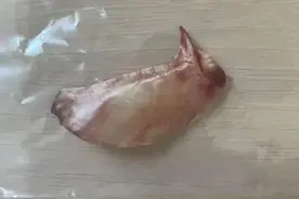 惊险！杭州一男子边吃边聊天，结果被刺直插心脏！医生：这么大的还是第一次见图片