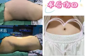 16岁女生腹涨如同怀孕，一查竟是“巨无霸”肿瘤！术后一看肚子，她懵了……图片