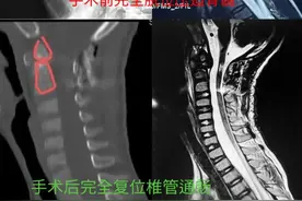 7岁男童突然高位截瘫，CT上看就像成了“断头人”，病因是……图片
