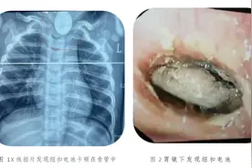 家长警惕！小小“纽扣电池”，竟成儿童夺命杀手图片