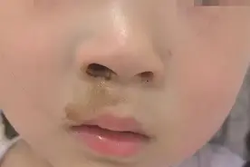 惊险！3岁女童将纽扣电池放入鼻腔，专家：幸好及时发现，严重可致鼻穿孔图片