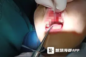 “太空漫步”玩嗨，泉州8岁女童摔断2颗门牙！图片