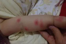 被蚊虫叮咬别大意 或引起过敏性休克图片