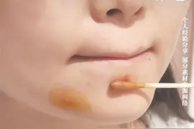 消毒剂变“美容圣品” 碘伏真能美白？图片