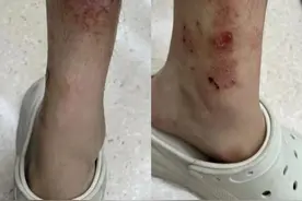 和女朋友游完西湖，男子双腿溃烂！医生：你对自己是真狠啊！图片