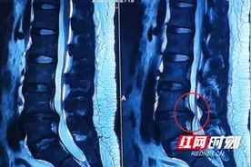 千方百计治腰未果 一针胶原酶还得轻松图片