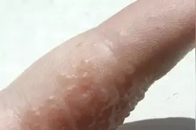 崩溃！姑娘体重暴涨20斤，手上密密麻麻长满疙瘩！竟和这事有关图片