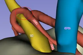 血管压迫三叉神经引发剧痛！3D可视化技术快速“解压除痛”图片