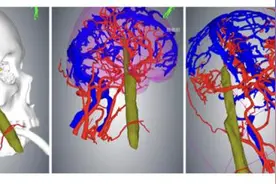 竹棍从男子面部插进大脑 医生借助“透视眼”取出脑内异物碎片图片