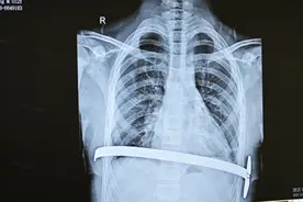 难以“挺”胸 孩子胸骨凹陷似漏斗？ 千万别轻视图片