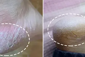 冬季手脚干裂、脱皮？睡前多一步，1招修复皮肤，软化角质、解决干裂、脱皮问题图片