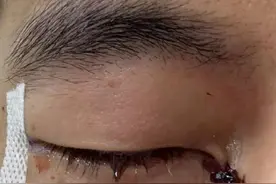突然受伤结膜破碎！郭艾伦：以后可能打不了篮球了……图片