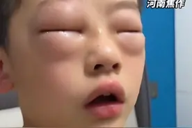 男孩每天双眼发肿，原来是……图片