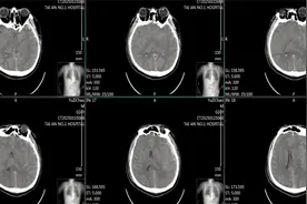 金的银的都不如自己的！泰安市第一人民医院：自体骨瓣修复术，为颅脑损伤患者“还原”完美颅骨图片
