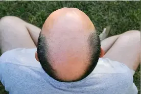 每五个成年男性就有一个“谢顶”！如何治疗？图片