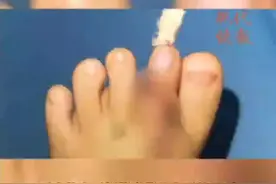 全国罕见！2岁女童多出的手指被移植到缺损脚趾图片