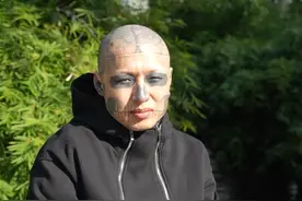 文面6年后小伙决定洗去文身：“很后悔，不要轻易尝试”图片