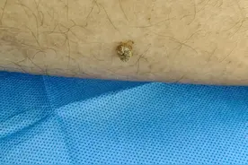 蜱虫又又又来了！别硬拔，已有人中招图片