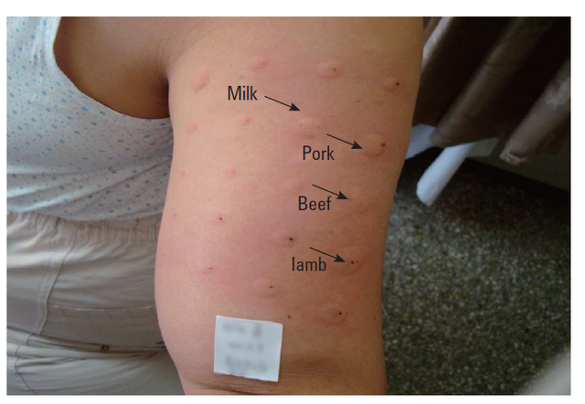 被这种小虫子叮咬后又吃了牛肉汉堡，47 岁飞行员竟因此突然死亡