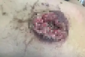 驻马店桐安肿瘤医院成功救治复杂背部鳞状细胞癌患者图片