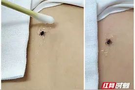 健康科普丨又到蜱虫活跃期，野外活动要警惕图片