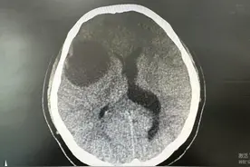 女子被头疼折磨三个月，一查竟是脑肿瘤！别觉得年轻就放松警惕图片