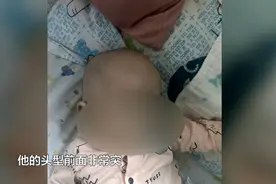 贵阳一孩子头型异常，家长没想到影响这么大！医生紧急提醒……图片