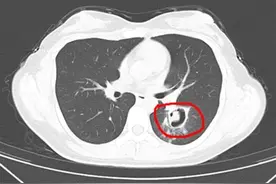 杭州女子清理旧物导致肺部长霉菌，此前已有多人中招，医生提醒打扫时需戴口罩图片