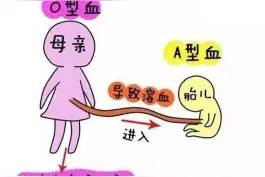 ABO溶血并非是谈虎色变的疾病图片