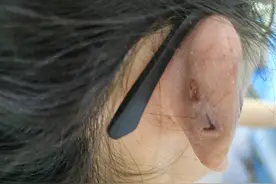 女大学生打耳骨钉后流脓血，就医发现软骨坏死、耳朵塌陷无法再生……图片