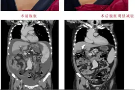 肝硬化患者反复呕血、便血……  青岛市中心医院实施手术为其重建“绿色生命通道”图片