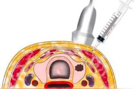 甲状腺结节要不要紧？超声引导下细针穿刺来帮忙图片