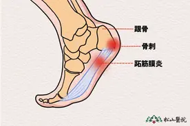 一走路就脚后跟痛？重庆松山医院：警惕跖筋膜炎、跟骨骨刺在作祟图片