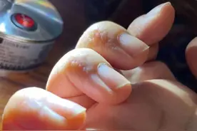 手上长这种透明小水疱，千万别挑破！图片