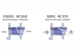 没有喉咙也能说话！中山一院用一粒“按钮”让患者发声图片