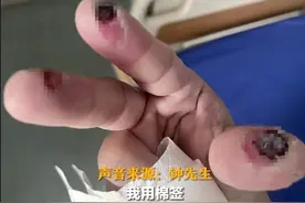 不小心碰了下，男子三根手指烂出黑洞！千万别心存侥幸图片