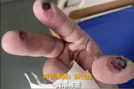 不小心碰了下，男子三根手指烂出黑洞！紧急提醒：不要心存侥幸图片