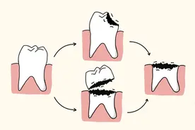 揭秘牙根保卫战：残根的保留与治疗方法图片