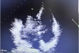 罕见！心脏长在右边？高难度手术圆满成功！图片